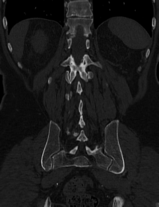 Anterior vertebral scalloping (abdominal aortic aneurysm) (Radiopaedia 66744-76067 Coronal bone window 56).jpg