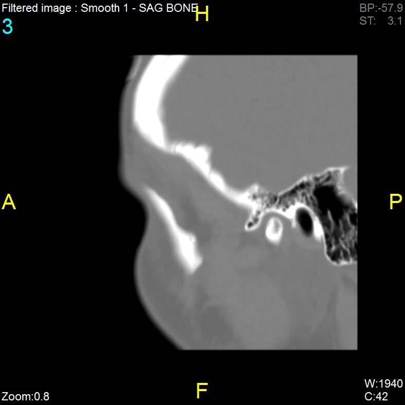 Antrochoanal polyp (Radiopaedia 65101-74094 Sagittal bone window 3).jpg