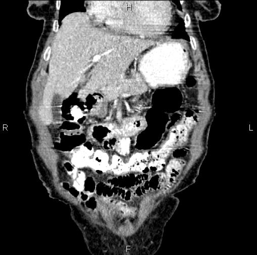 Aortic aneurysm and Lemmel syndrome (Radiopaedia 86499-102554 C 14).jpg