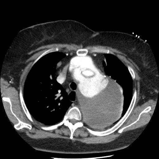 File:Aortic aneurysm and dissection - Stanford type A (Radiopaedia 36693-38261 A 20).png
