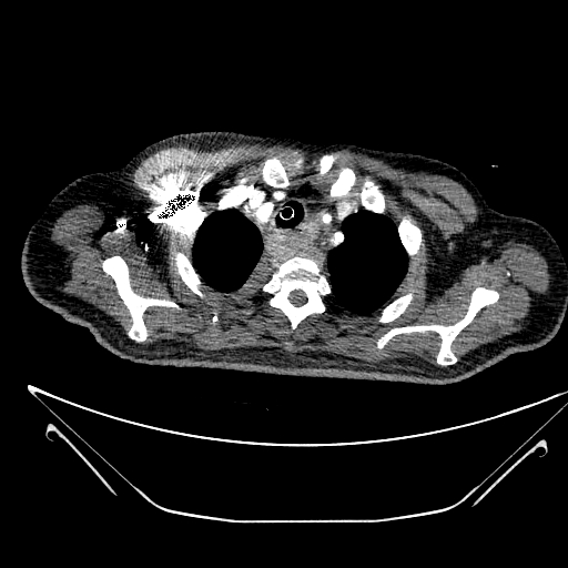 Aortic arch aneurysm (Radiopaedia 84109-99365 B 103).jpg