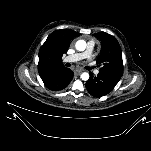 Aortic arch aneurysm (Radiopaedia 84109-99365 B 297).jpg