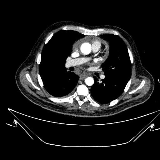 Aortic arch aneurysm (Radiopaedia 84109-99365 B 310).jpg
