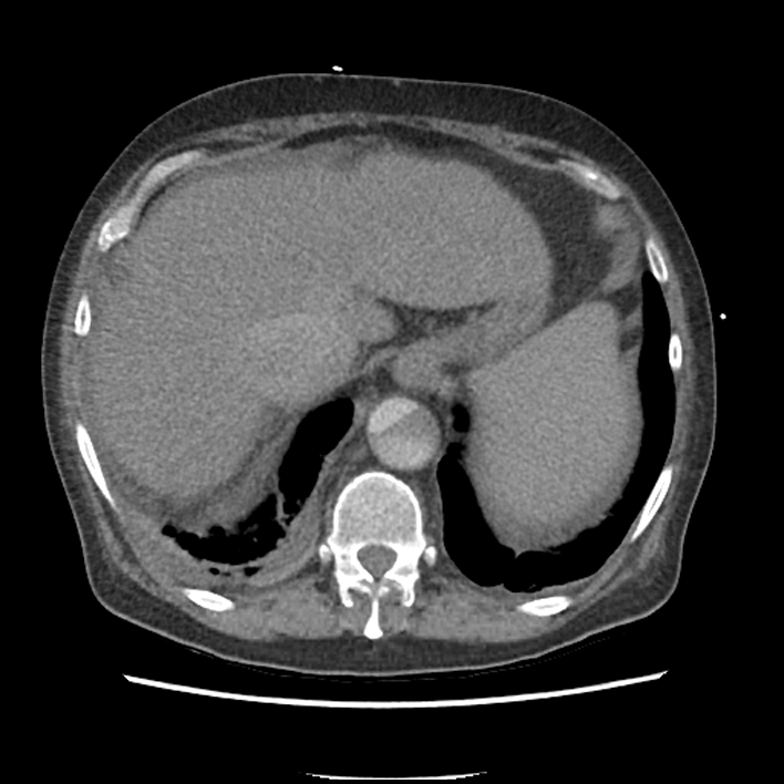 Aortic arch graft infection (FDG PET-CT) (Radiopaedia 71975-82437 A 55).jpg