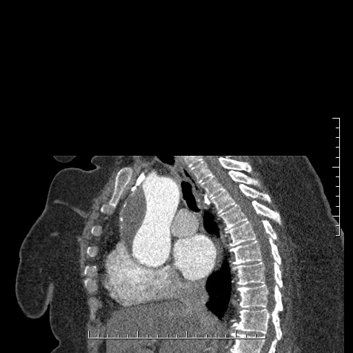 File:Aortic dissection- Stanford A (Radiopaedia 35729-37268 D 33).jpg