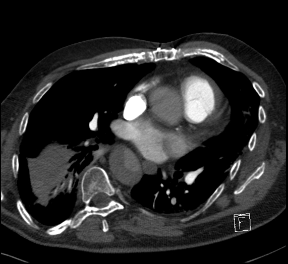File:Aortic dissection (CTPA) (Radiopaedia 75506-86751 Axial C+ CTPA 77).jpg