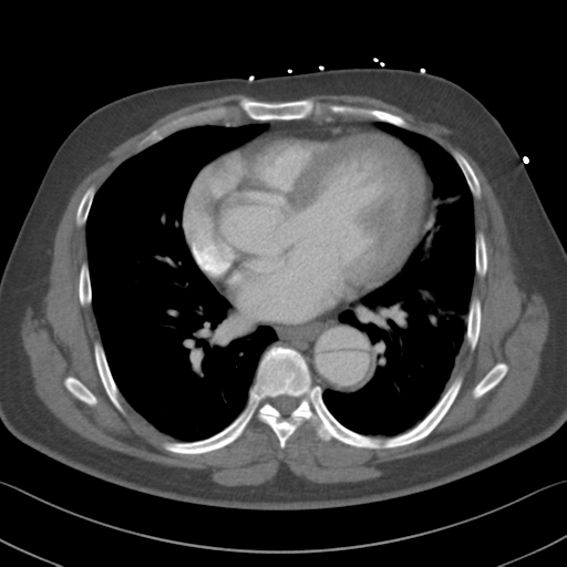 File:Aortic dissection (Radiopaedia 50763-56234 A 41).png