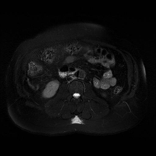 File:Aortic dissection (Radiopaedia 57969-64956 Axial T2 fat sat 38).jpg