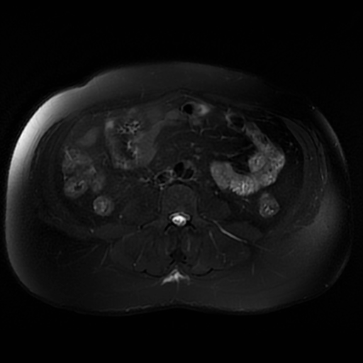 File:Aortic dissection (Radiopaedia 57969-64956 Axial T2 fat sat 43).jpg