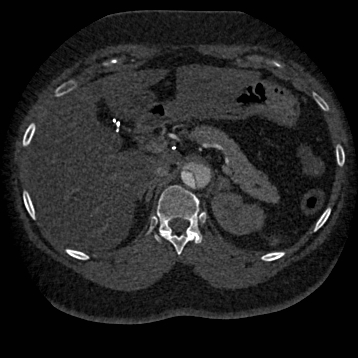 File:Aortic dissection (Radiopaedia 57969-64959 A 328).jpg
