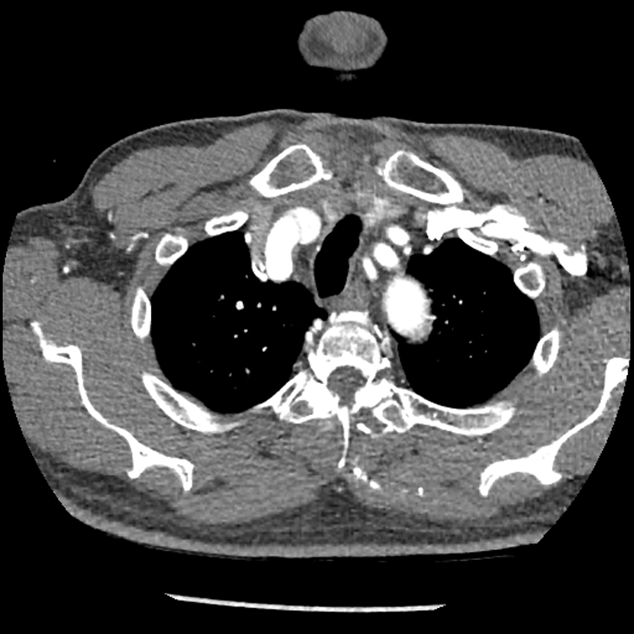 Aortic dissection - DeBakey Type I-Stanford A (Radiopaedia 79863-93115 A 4).jpg