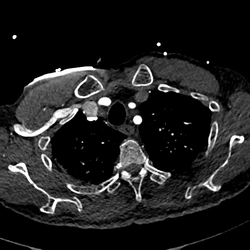 File:Aortic dissection - DeBakey type II (Radiopaedia 64302-73082 A 17).png