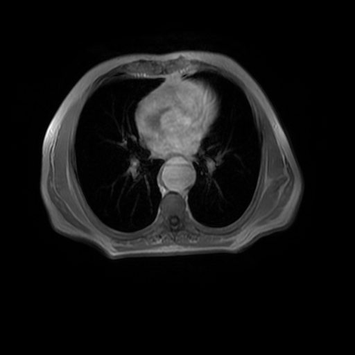 File:Aortic dissection - Stanford A - DeBakey I (Radiopaedia 23469-23551 Axial MRA 20).jpg