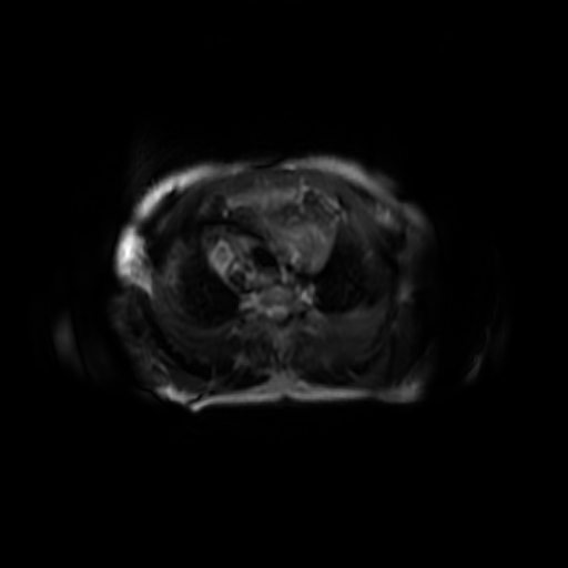 File:Aortic dissection - Stanford A - DeBakey I (Radiopaedia 23469-23551 Axial T2 fat sat 1).jpg