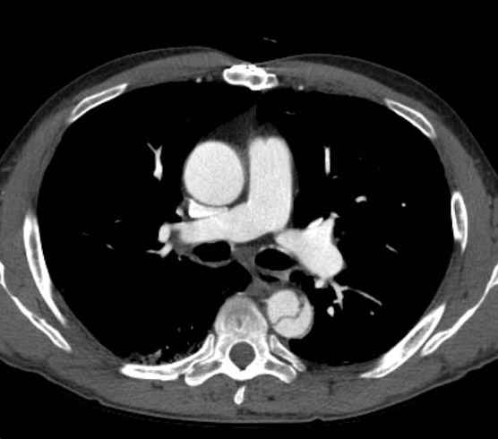 File:Aortic dissection - Stanford type B (Radiopaedia 73648-84437 A 43).jpg