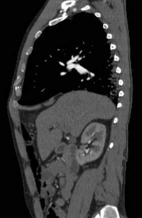 File:Aortic dissection - Stanford type B (Radiopaedia 73648-84437 C 105).jpg
