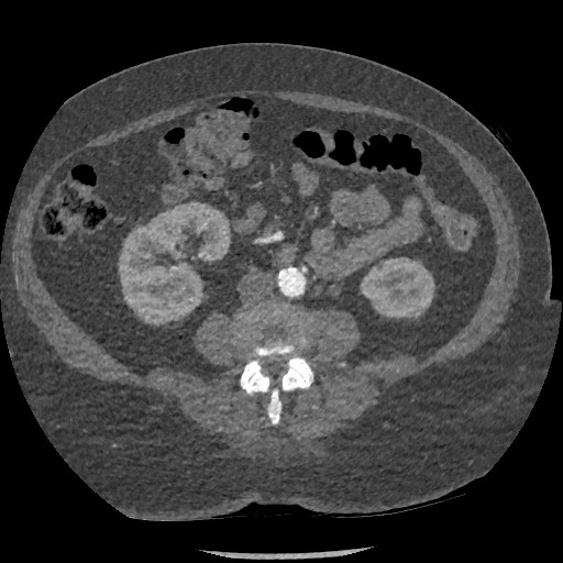 File:Aortic dissection - Stanford type B (Radiopaedia 88281-104910 A 126).jpg