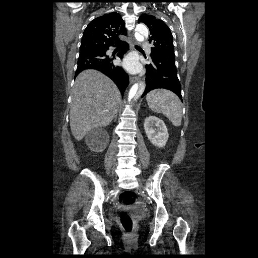 File:Aortic dissection - Stanford type B (Radiopaedia 88281-104910 B 52).jpg