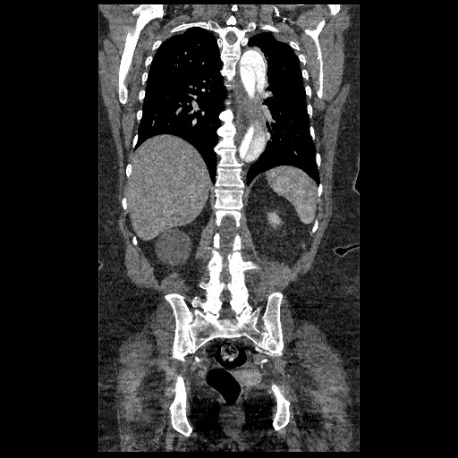 File:Aortic dissection - Stanford type B (Radiopaedia 88281-104910 B 61).jpg