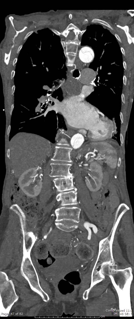 Aortic dissection with extension into aortic arch branches (Radiopaedia 64402-73204 A 47).jpg
