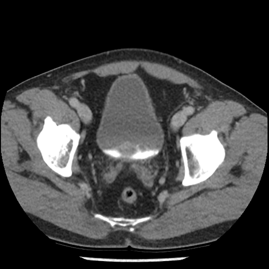 Aortic intramural hematoma (type B) (Radiopaedia 79323-92387 Axial C+ delayed 106).jpg