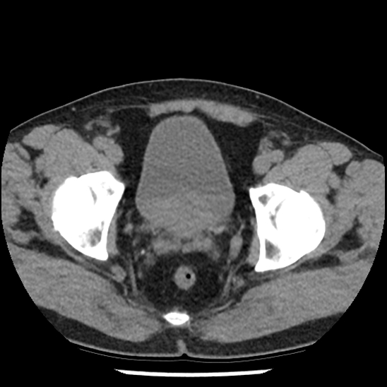 Aortic intramural hematoma (type B) (Radiopaedia 79323-92387 Axial non-contrast 108).jpg