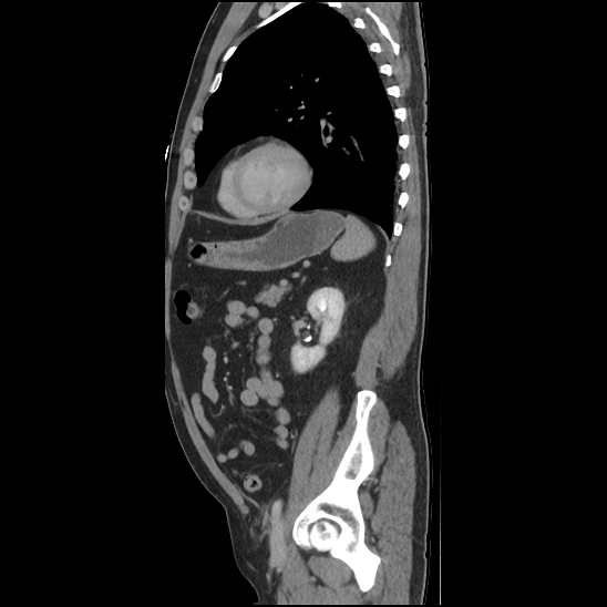 Aortic intramural hematoma (type B) (Radiopaedia 79323-92387 Sagittal C+ delayed 39).jpg