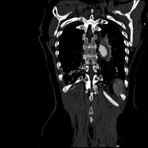 File:Aortic intramural hematoma from penetrating atherosclerotic ulcer (Radiopaedia 31137-31836 C 58).jpg