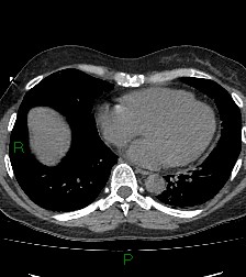 Aortic valve endocarditis (Radiopaedia 87209-103485 Axial non-contrast 68).jpg