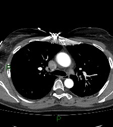Aortic valve endocarditis (Radiopaedia 87209-103485 C 35).jpg