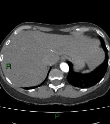 File:Aortic valve endocarditis (Radiopaedia 87209-103485 C 85).jpg