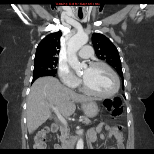 File:Aortic valve stenosis (Radiopaedia 14480-14423 A 9).jpg