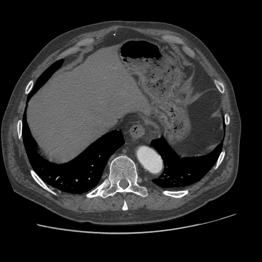 File:Aorto-coronary bypass graft aneurysms (Radiopaedia 40562-43157 A 103).png