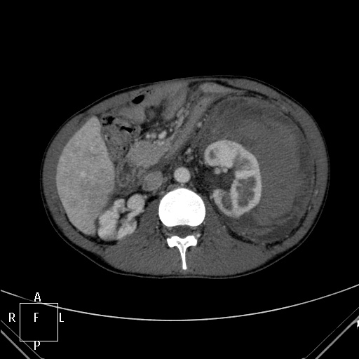 File:Aorto-left renal vein fistula (Radiopaedia 45534-49628 A 24).jpg