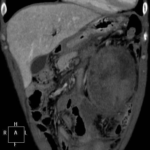 Aorto-left renal vein fistula (Radiopaedia 45534-49628 B 7).jpg