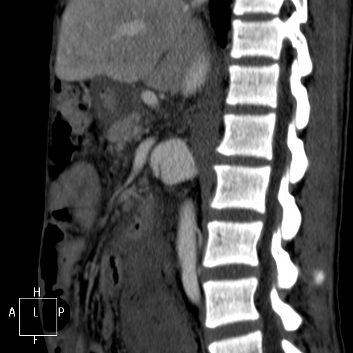 Aorto-left renal vein fistula (Radiopaedia 45534-49628 C 30).jpg