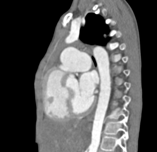 File:Aortopulmonary window, interrupted aortic arch and large PDA giving the descending aorta (Radiopaedia 35573-37074 C 22).jpg
