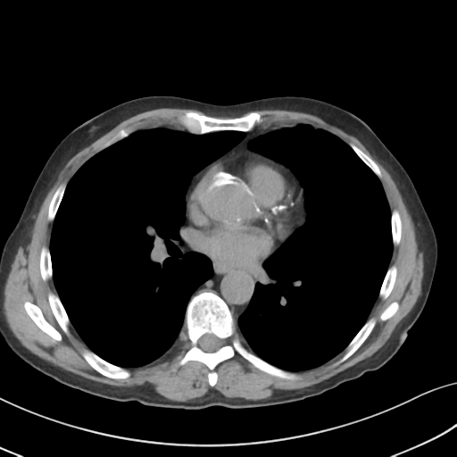 Apical pulmonary metastasis (Radiopaedia 46338-50754 B 36).png