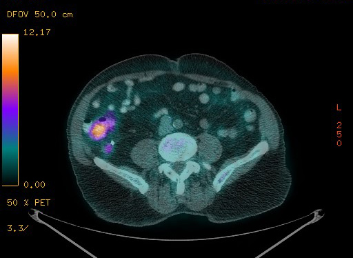 Appendiceal adenocarcinoma complicated by retroperitoneal abscess (Radiopaedia 58007-65041 Axial PET-CT 148).jpg