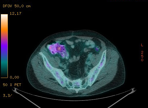 Appendiceal adenocarcinoma complicated by retroperitoneal abscess (Radiopaedia 58007-65041 Axial PET-CT 168).jpg