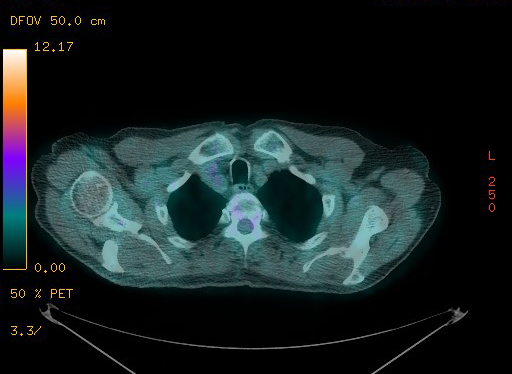 Appendiceal adenocarcinoma complicated by retroperitoneal abscess (Radiopaedia 58007-65041 Axial PET-CT 37).jpg