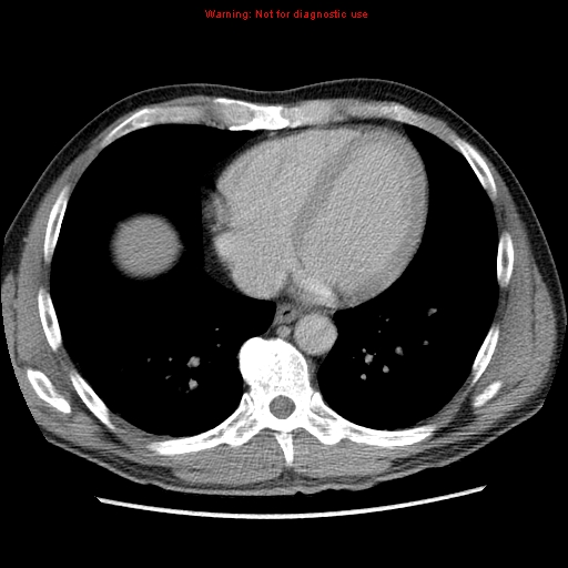 File:Appendicitis and renal cell carcinoma (Radiopaedia 17063-16760 A 1).jpg
