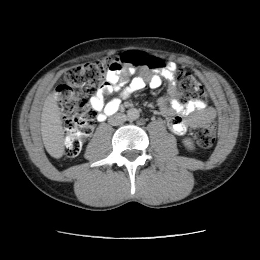 File:Appendicitis complicated by post-operative collection (Radiopaedia 35595-37113 A 36).jpg