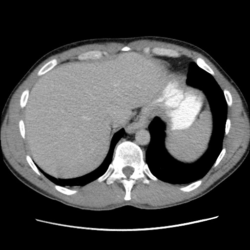 File:Appendicitis complicated by post-operative collection (Radiopaedia 35595-37114 A 15).jpg