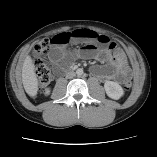 Appendicitis complicated by post-operative collection (Radiopaedia 35595-37114 A 42).jpg
