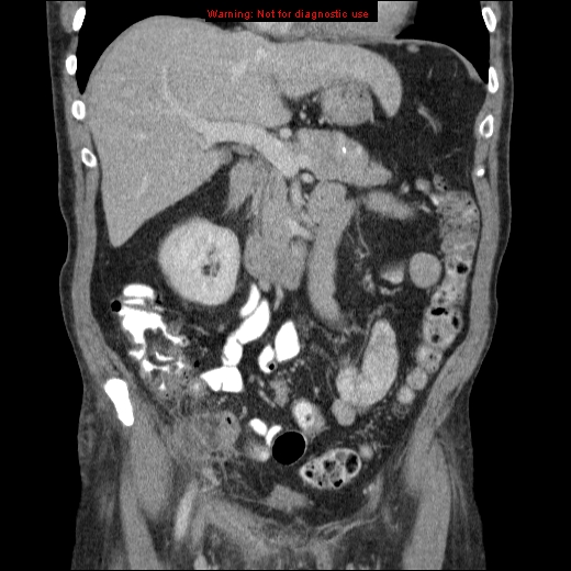 File:Appendicitis mass in inguinal hernia (Radiopaedia 26858-27029 B 28).jpg