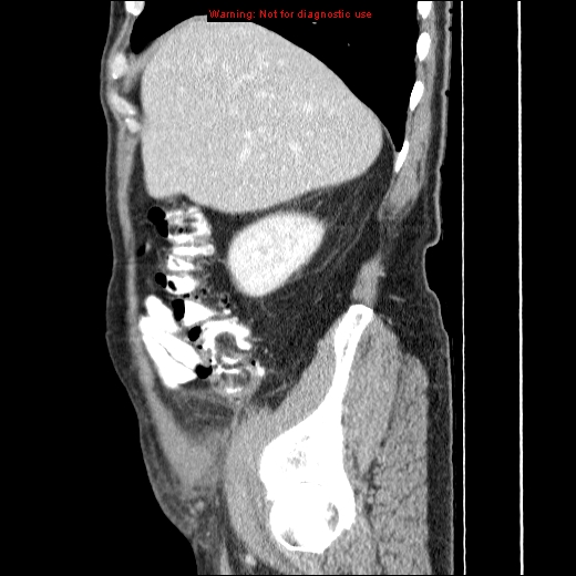 File:Appendicitis mass in inguinal hernia (Radiopaedia 26858-27029 C 10).jpg