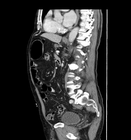 File:Appendicitis with localized perforation and abscess formation (Radiopaedia 49035-54130 C 37).jpg