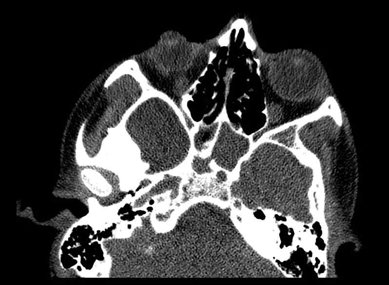 Arachnoid cyst- extremely large (Radiopaedia 68741-78450 Axial bone window 10).jpg
