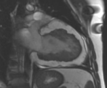 Arrhythmogenic right ventricular cardiomyopathy (Radiopaedia 69431-79307 2ch cine 30).jpg